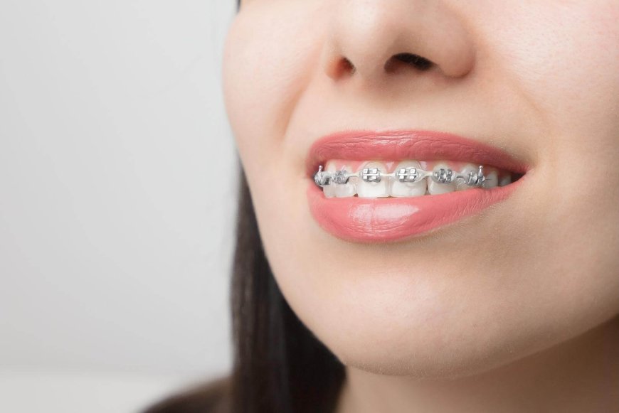 The Modern Solution: How Self-Ligating Braces Are Transforming Orthodontic Treatment