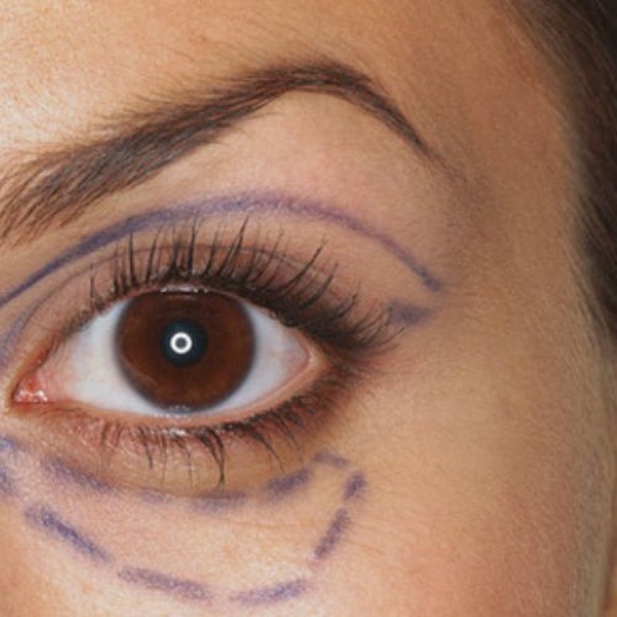 What You Should Know About Blepharoplasty in South Africa