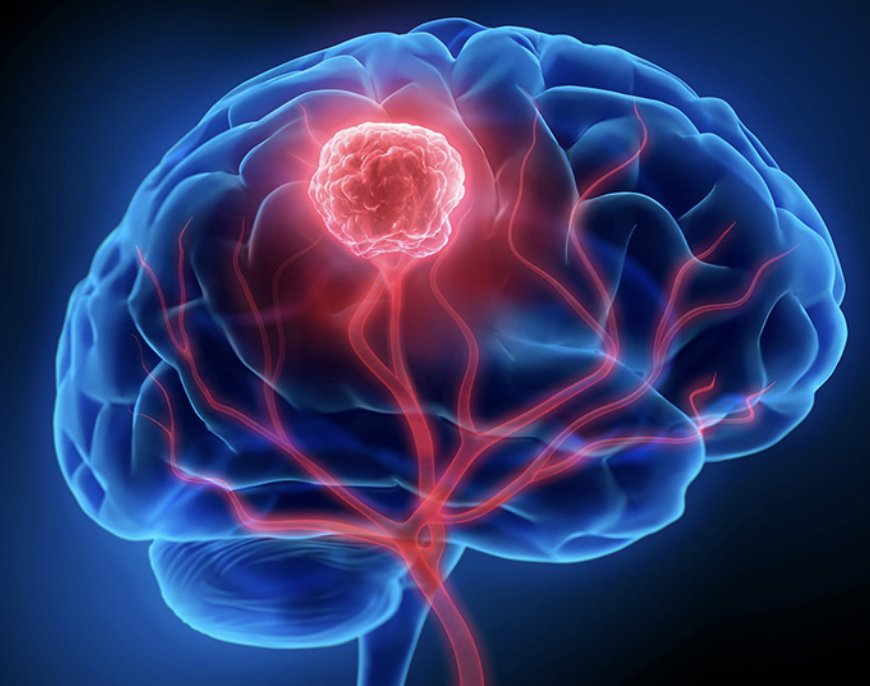 Brain Tumor Surgery in Haryana with Dr. Vikas Kathuria