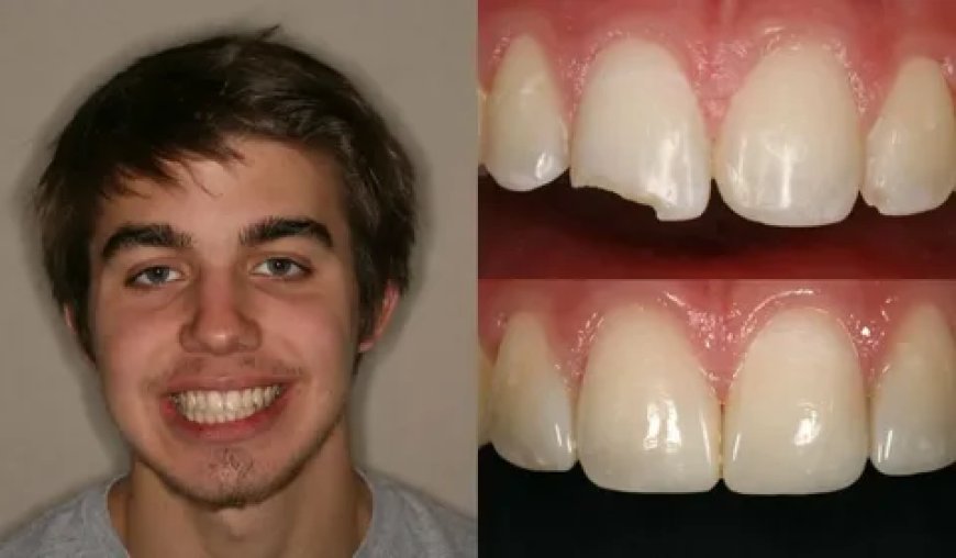 Discover The Magic Of Teeth Whitening In Rochdale For A Brighter Smile