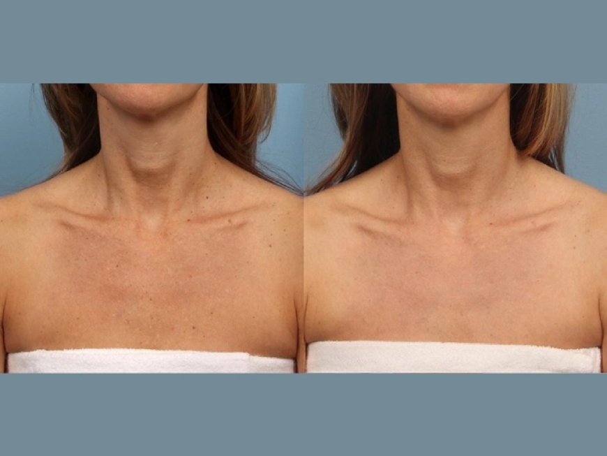 Flawless Confidence with Moxi Laser Treatment from the Best Plastic Surgeon in Dubai