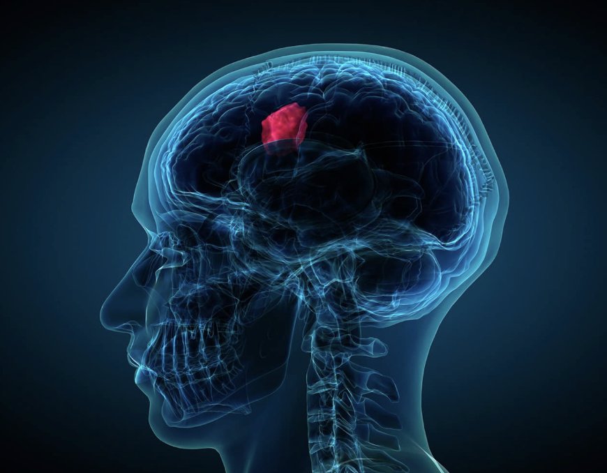Advanced Brain Tumor Surgery in Gurgaon by Dr. Vikas Kathuria
