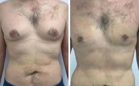 How Technology and Skill Combine in the Hands of the Best Doctors in Dubai for Gynecomastia Surgery