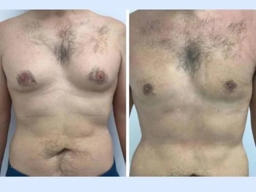 How Technology and Skill Combine in the Hands of the Best Doctors in Dubai for Gynecomastia Surgery